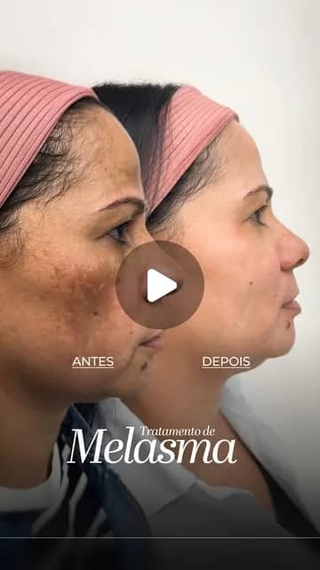 Comparação de antes e depois de tratamento de melasma, em imagem publicada pela clínica
