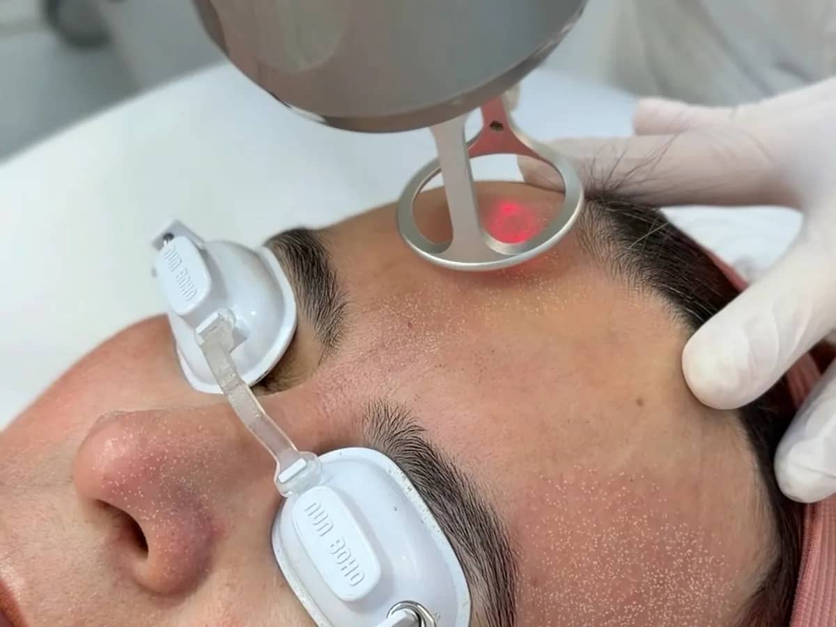 Aparelho de laser CO₂ fracionado posicionado sobre o rosto de uma cliente