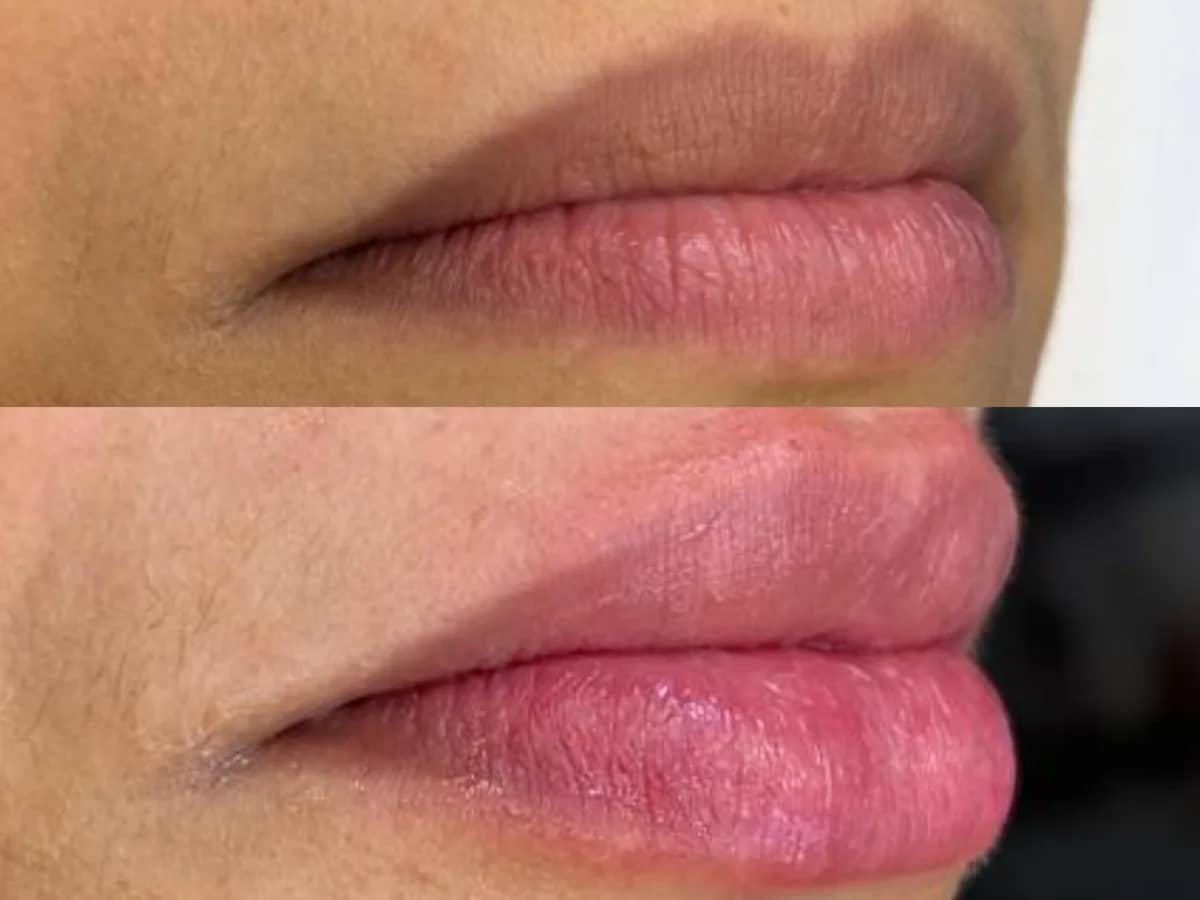 Comparação de dois momentos dos lábios de uma mulher em close, o segundo com mais volume e contorno mais definido