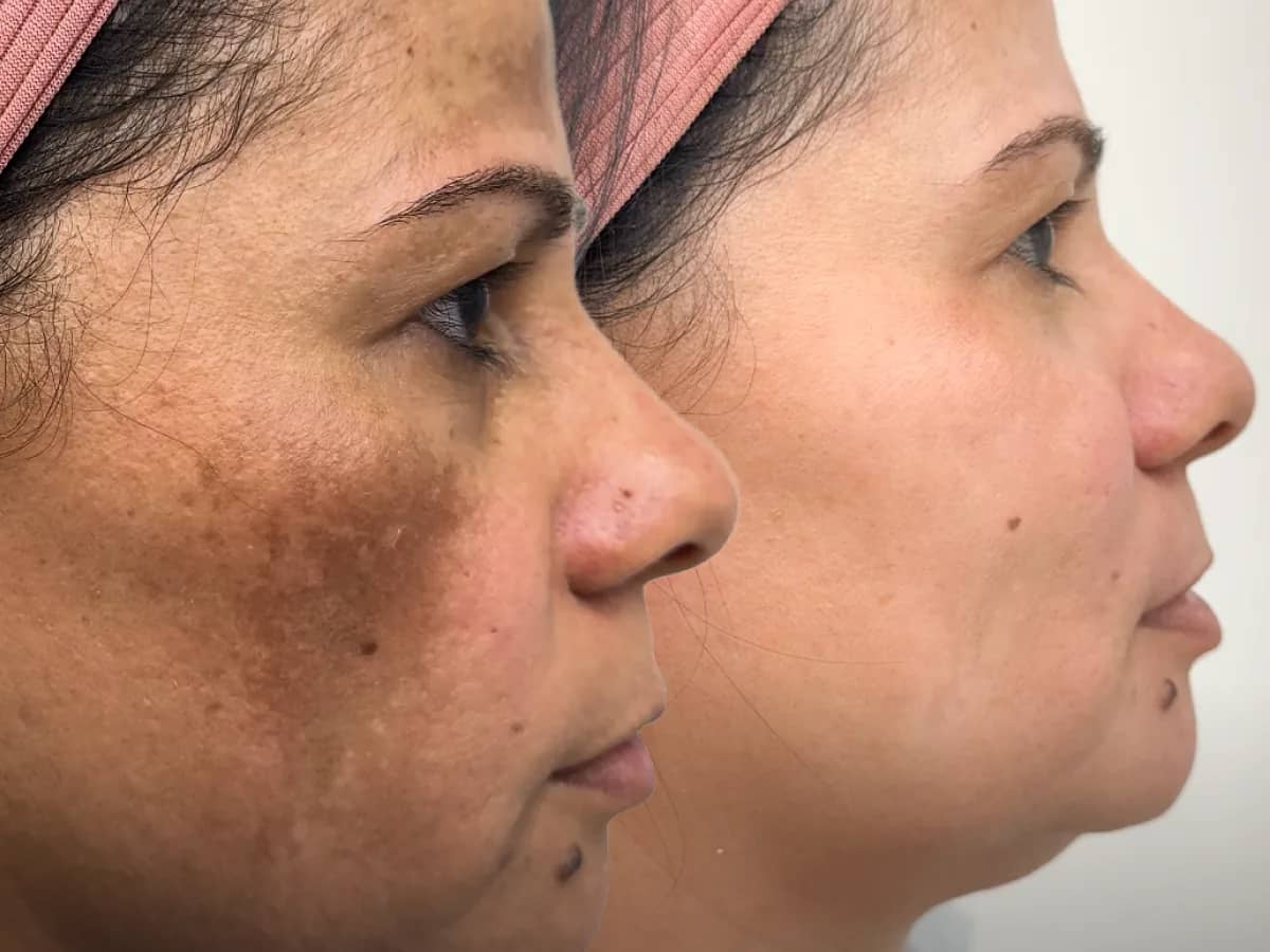 Comparação de dois momentos do rosto de uma mulher com manchas nas maçãs do rosto e na têmpora