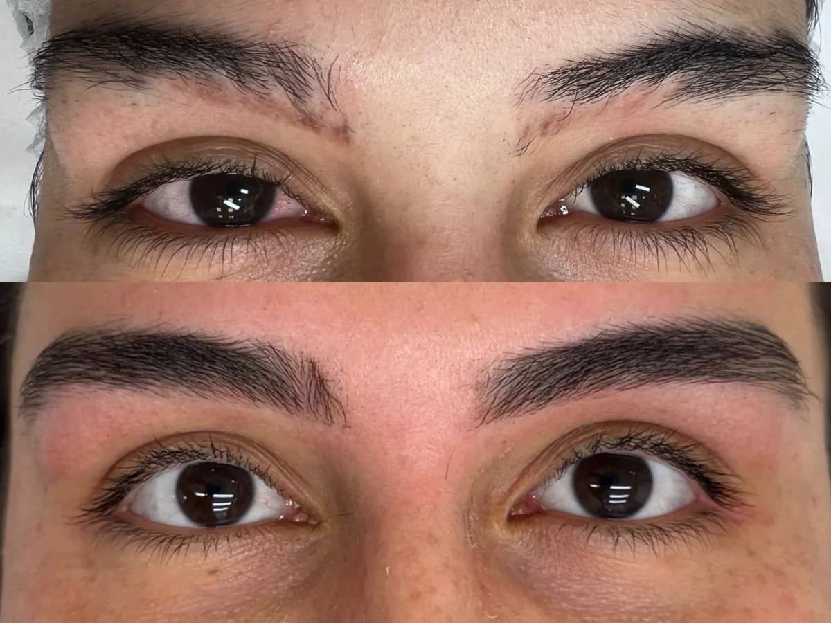 Comparação de dois momentos das sobrancelhas de uma mulher, antes e depois de protocolo de fortalecimento dos fios