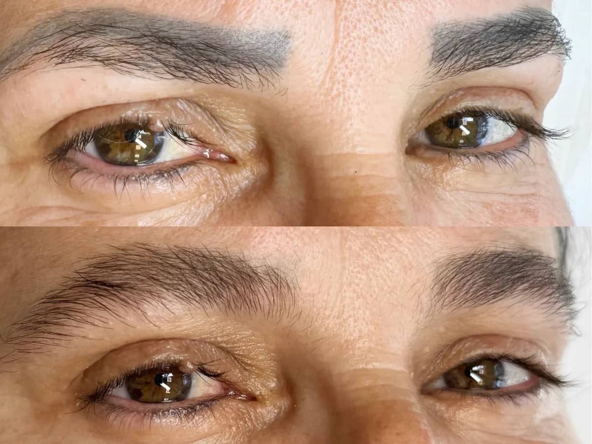 Comparação de dois momentos das sobrancelhas de uma mulher, antes e depois de sessões de remoção de micropigmentação a laser