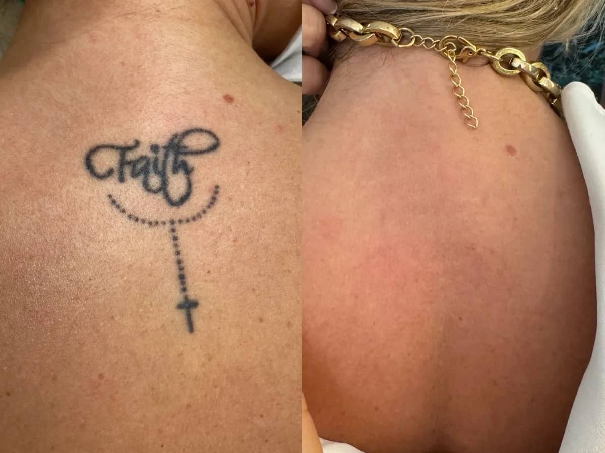 Comparação de dois momentos de uma tatuagem escrita no ombro, antes e depois de sessões de remoção a laser