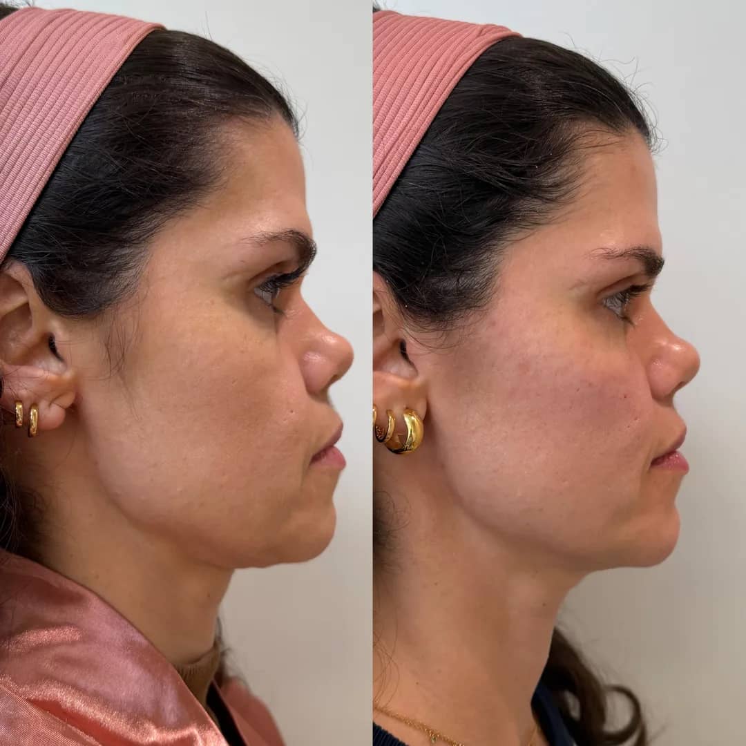 Antes e depois de bioestimulador de colágeno, rosto de perfil