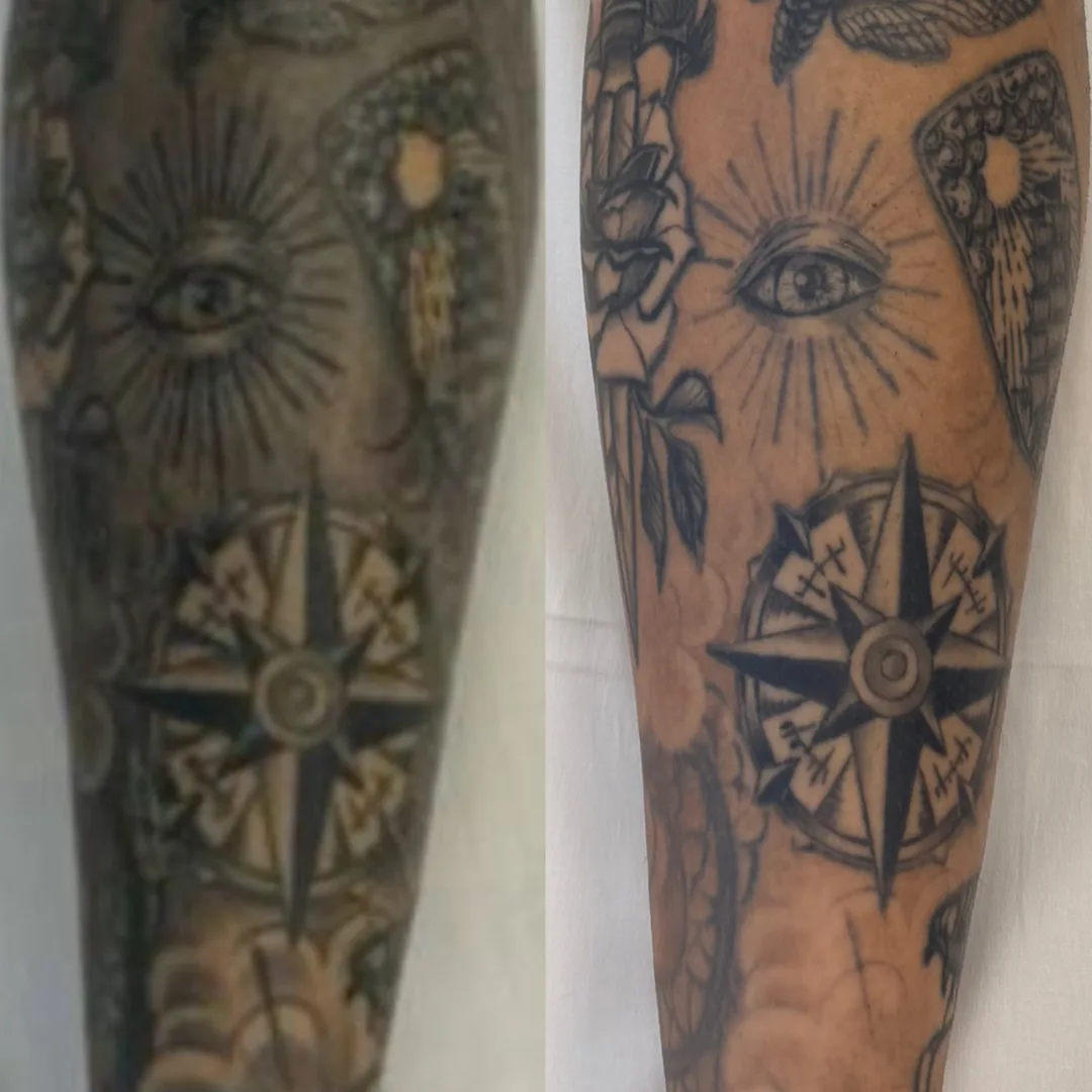 Antes e depois de remoção de tatuagem a laser no braço