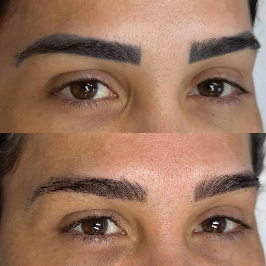 Antes e depois de remoção de micropigmentação de sobrancelhas