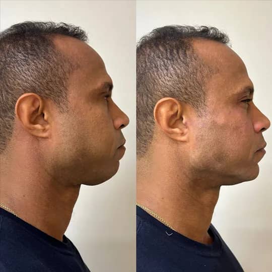 Antes e depois de contorno facial, perfil masculino