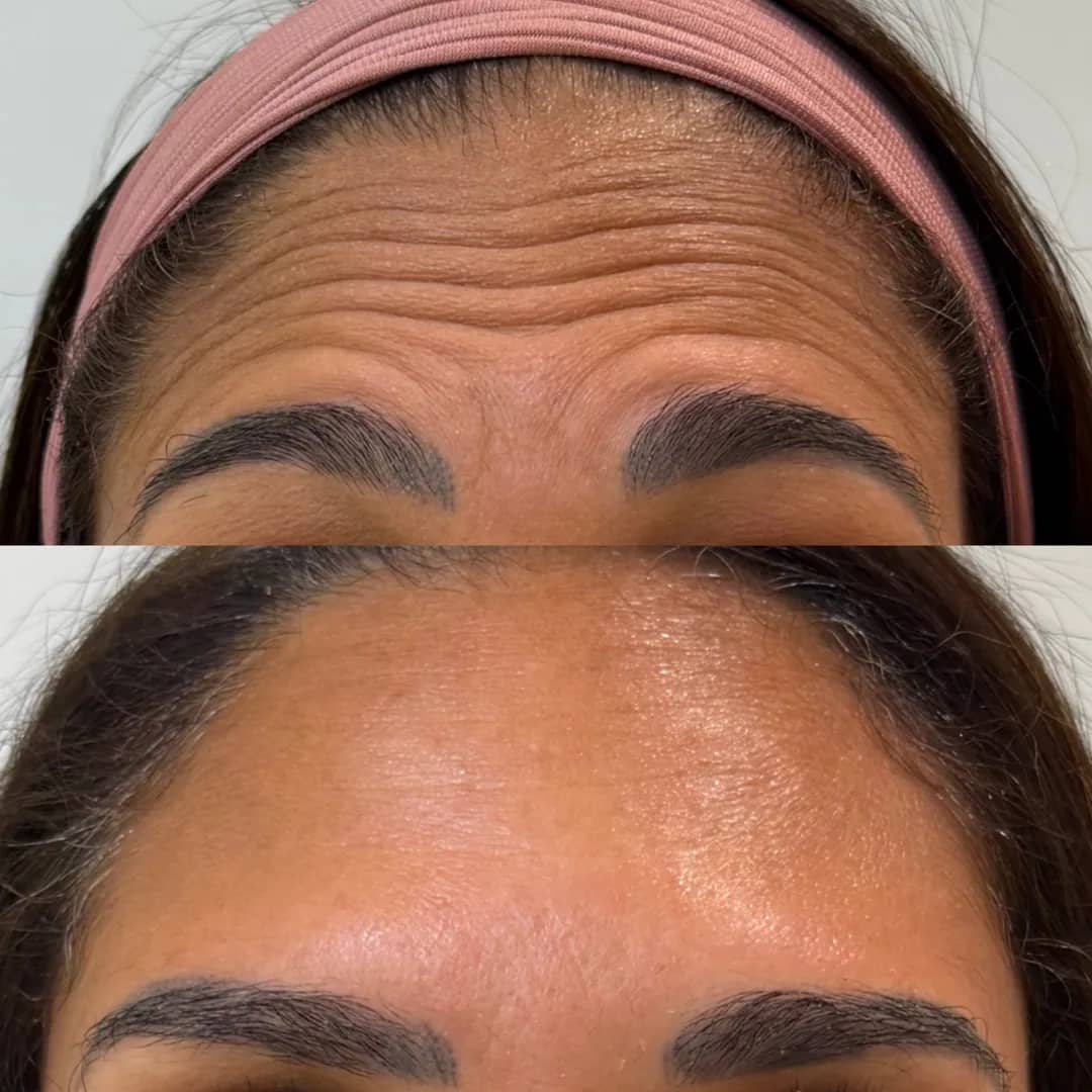 Antes e depois de tratamento para suavizar as linhas da testa