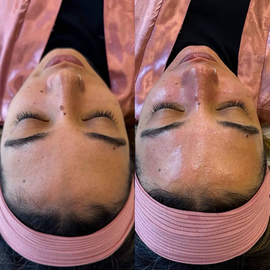 Antes e depois de limpeza de pele, rosto visto de cima